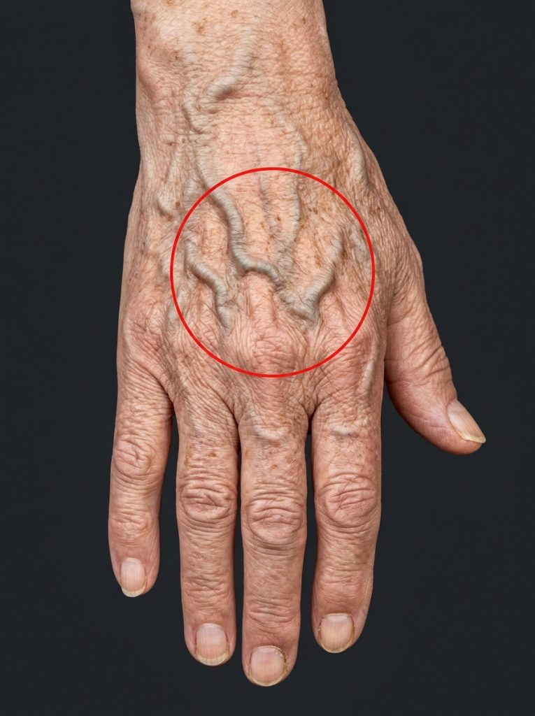 WHAT THE VEINS ON YOUR HANDS MIGHT REVEAL ABOUT YOUR KIDNEY HEALTH